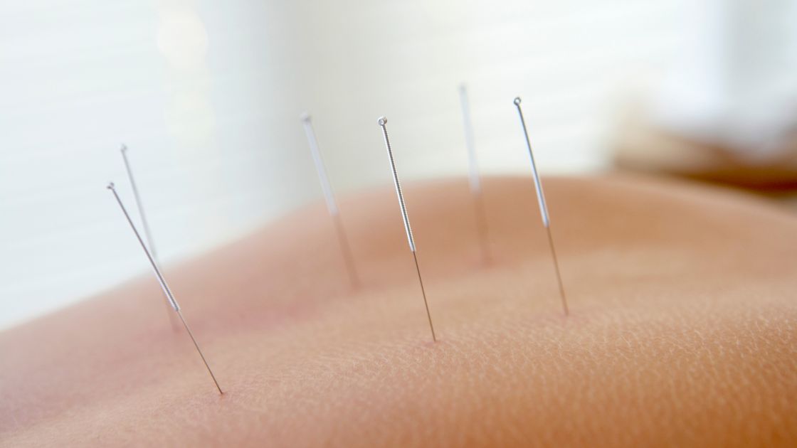 A person lying down with accupuncture needles in their back