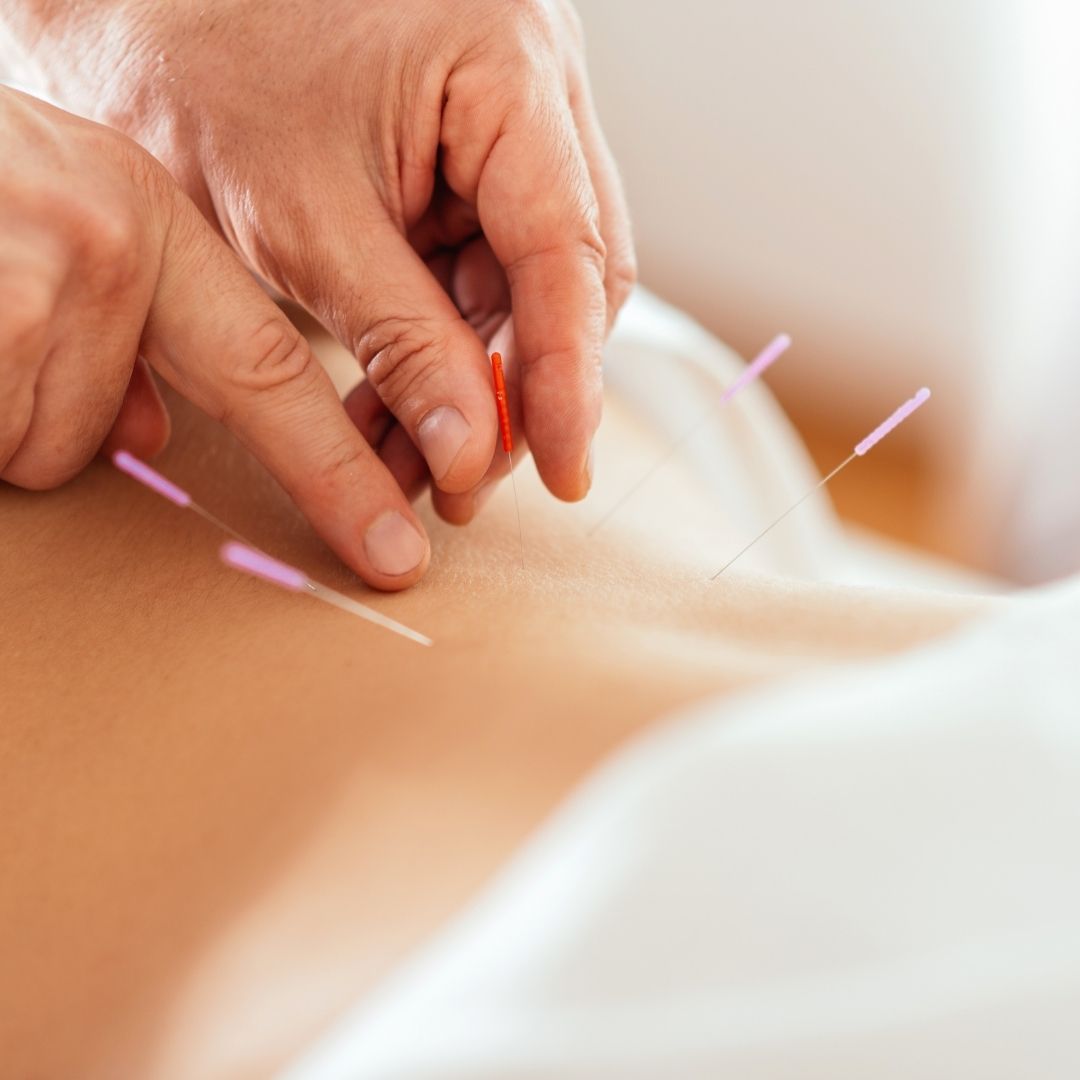 A professional inserting acupuncture needles into a client